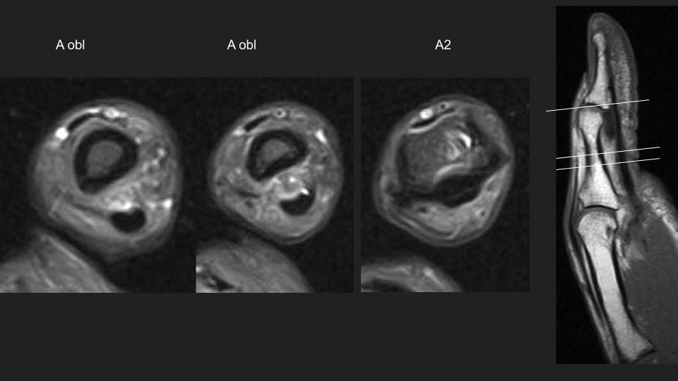 Figure 4 for case annular pulley of finger ( RID2435 )
